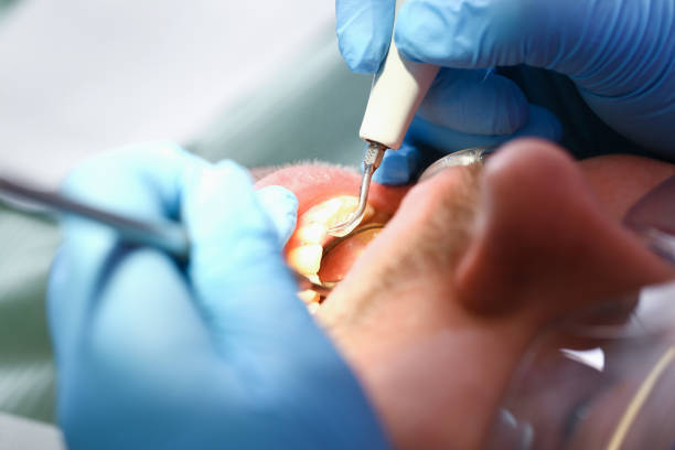 Best Emergency Tooth Extraction in Atwater, CA